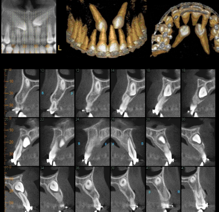 TAC dental y radiografías 3D :: Clínica Dental Pérez Ballesteros en Salamanca, atención integral de las enfermedades buco-dentales y tratamientos odontológicos